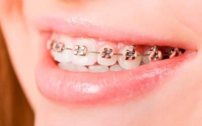 Teeth Straightening Options in Australia