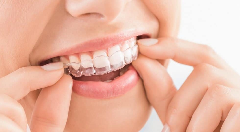 Clear Braces Central Coast Orthodontics