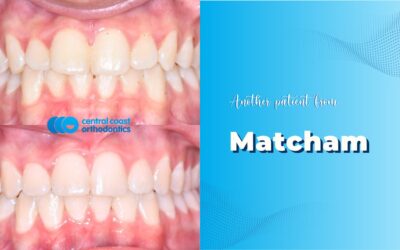 Patient of Matcham’s Braces Makeover
