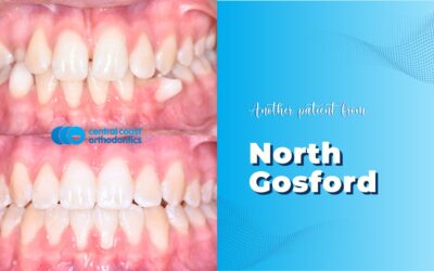Patient of North Gosford’s Braces Makeover