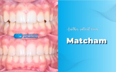 Patient of Matcham’s Braces Makeover