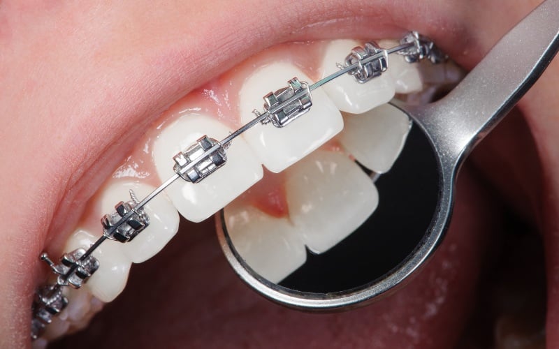 Beyond Just Braces How We Support Your Entire Family Through the Orthodontic Journey