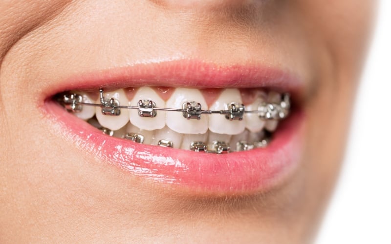 True Emergency or Minor Hiccup Understanding When Your Orthodontic Issue Needs Immediate Attention