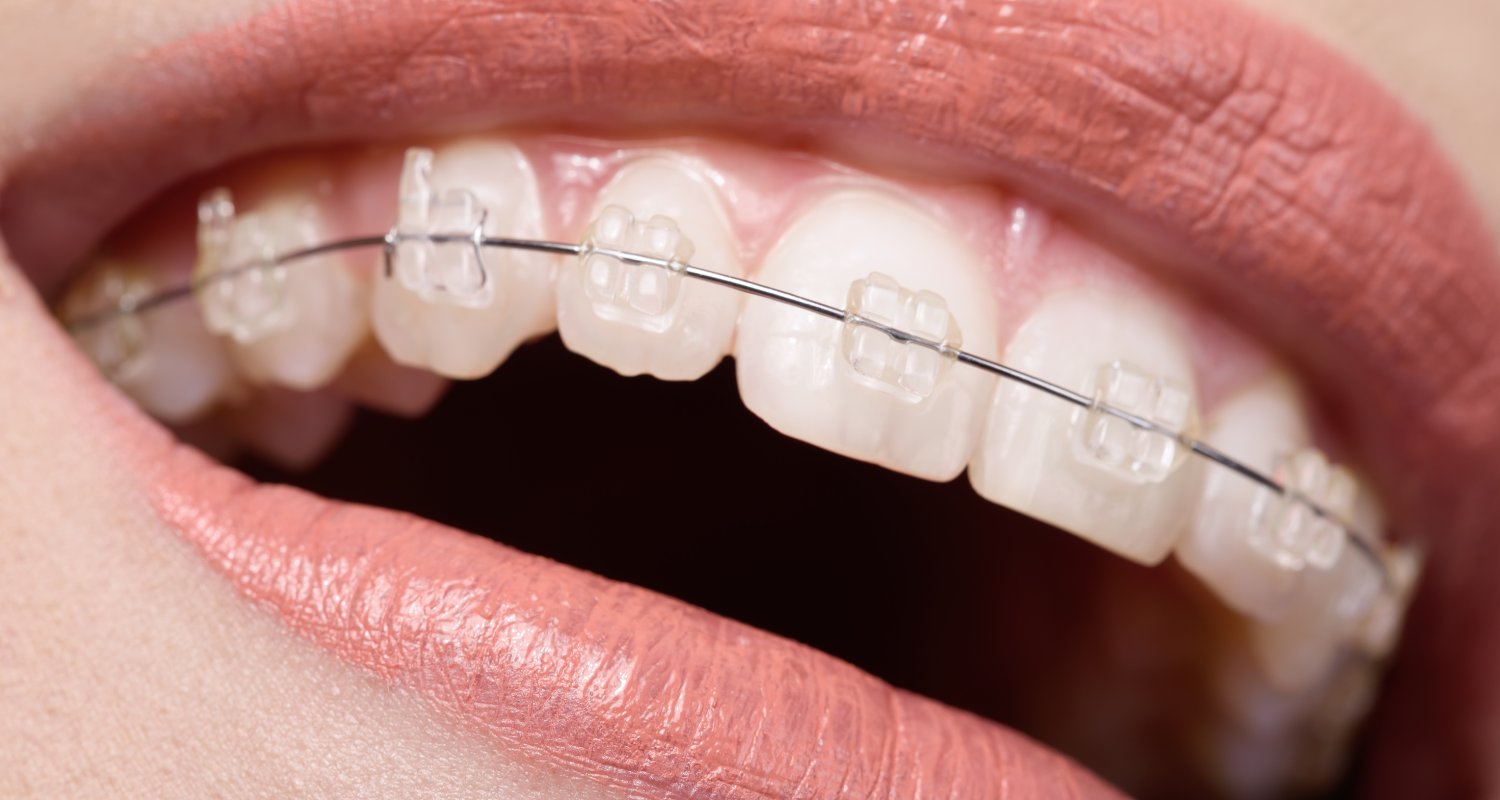 True Emergency or Minor Hiccup Understanding When Your Orthodontic Issue Needs Immediate Attention