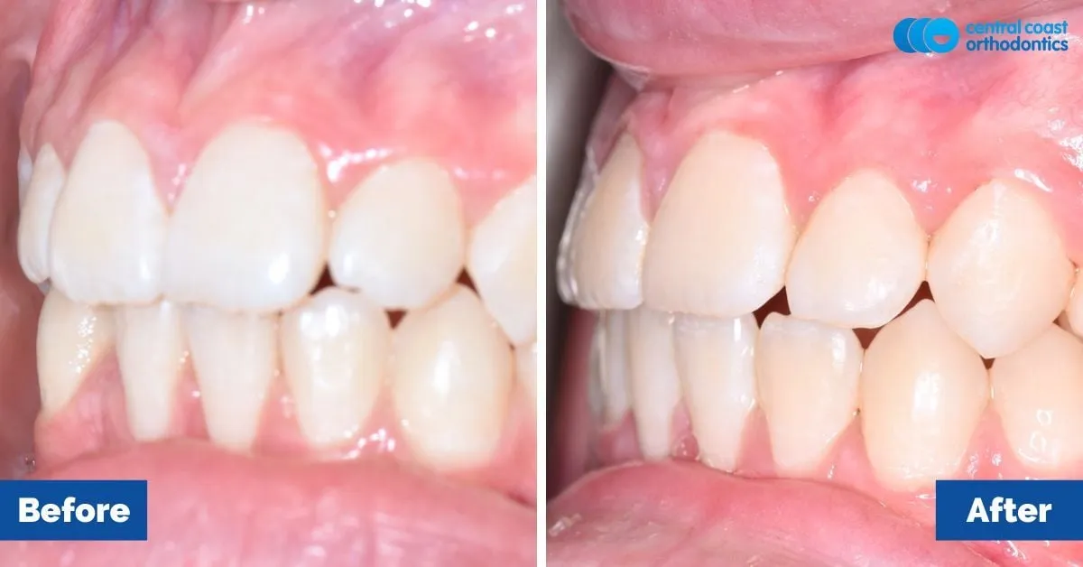 Before and after comparison, side view of the upper and lower teeth