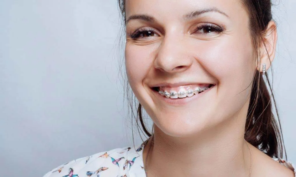 Young woman smiling with braces on her upper and lower teeth