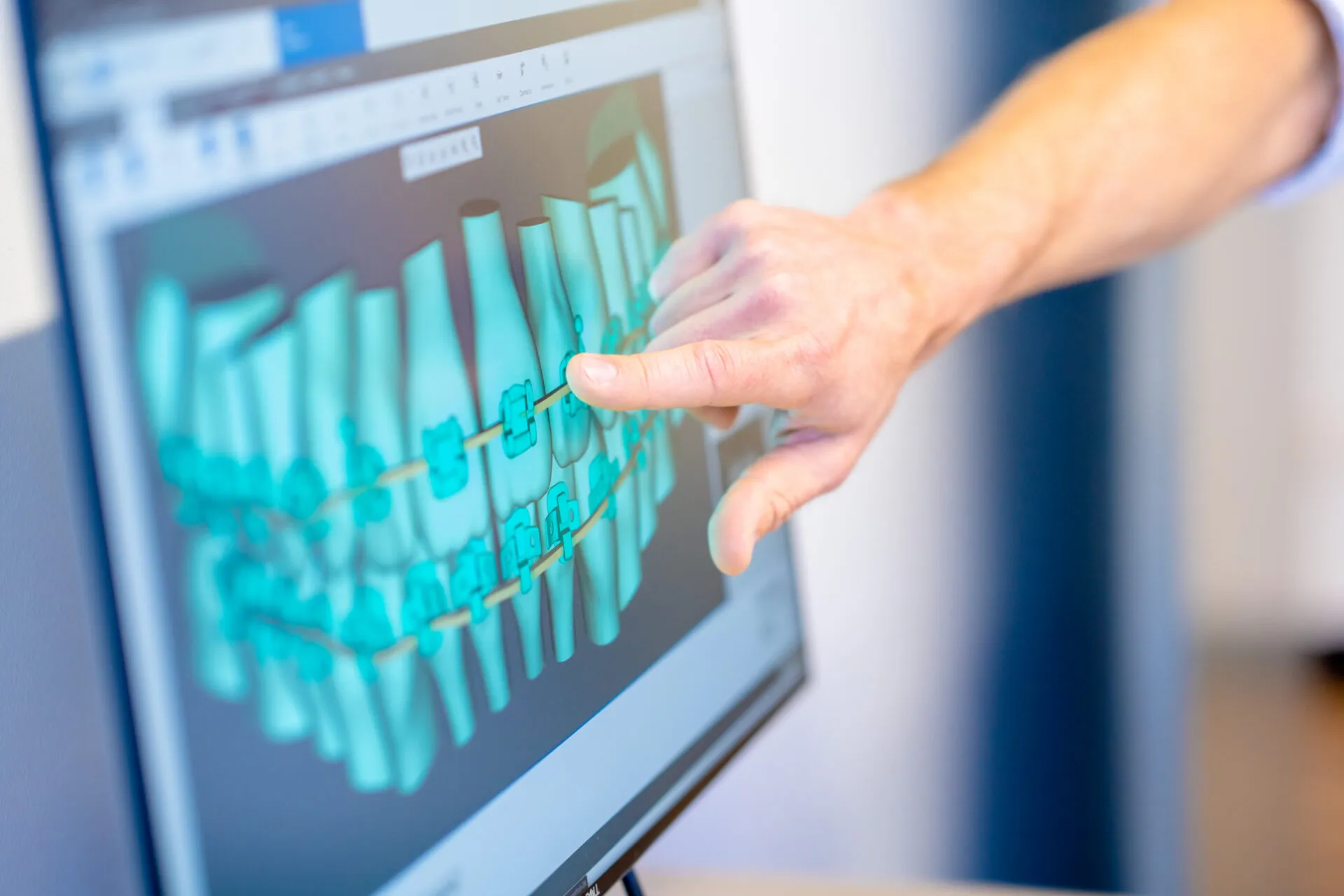 Hand pointing at a screen showing a 3D digital scan of a dental arch
